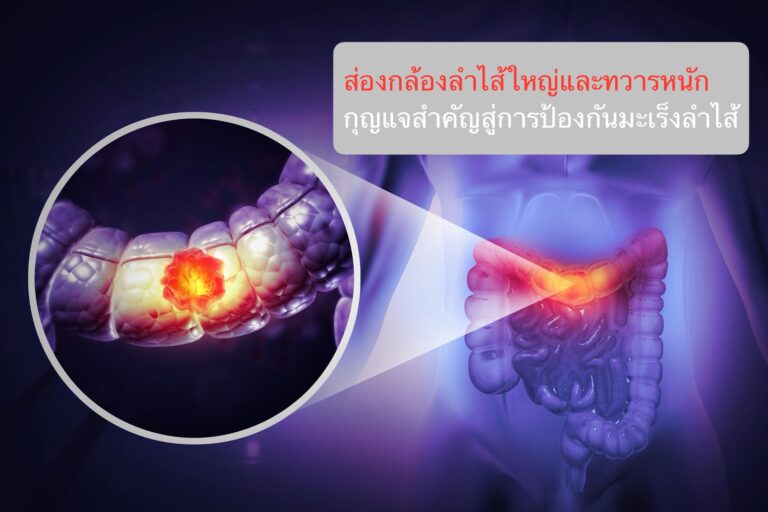ส่องกล้องลำไส้ใหญ่และทวารหนัก กุญแจสำคัญสู่การป้องกันมะเร็งลำไส้